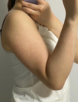 韩国德社罗伊瘦手臂案例展示，术后一个月对比效果曝光！_术前