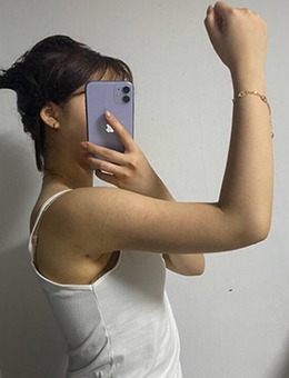 韩国德社罗伊瘦手臂日记展示，术后一个月对比效果曝光！