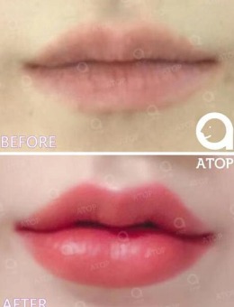 唇部填充玻尿酸术后有效吗？看看韩国爱她整形医院唇部改善案例！