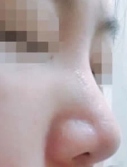 韩国首尔整形外科隆鼻真人案例对比图！_术前