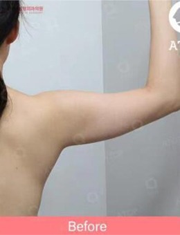 韩国爱她整形医院手臂吸脂案例，恢复期照片公布！_术前