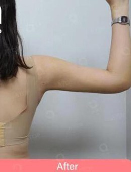韩国爱她整形医院手臂吸脂案例，恢复期照片公布！_术后