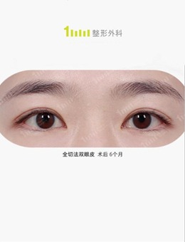 韩国1mm整形医院内双做双眼皮效果图
