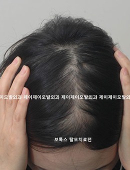 女生发缝稀疏可以用植发解决!看韩国医院植发效果