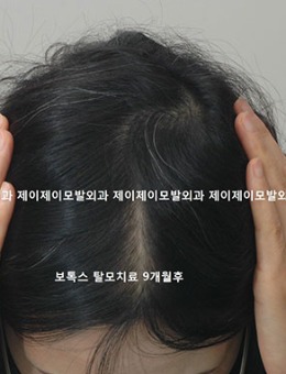 -女生发缝稀疏可以用植发解决!看韩国医院植发效果