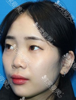 韩国江南富帝医院鼻子太塌改善案例前后对比