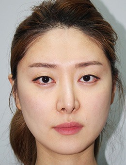 -韩国现代美学做鼻修复效果如何，看真人术后6个月改善案例！
