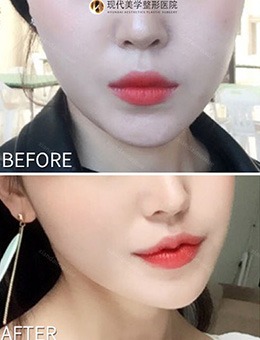 -韩国现代美学M唇+嘴角上扬术案例对比，唇形改善效果看得见！