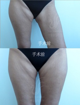韩国首尔slim外科医院大腿内侧赘皮整形切除需要多钱_术前