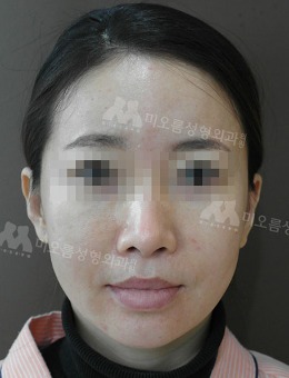 韩国美思科整形心形线提升对比照片