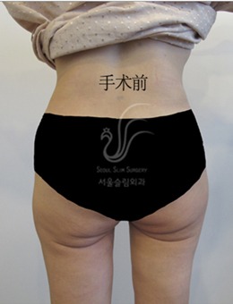韩国首尔slim外科医院臀部赘皮切除手术前后对比照分享_术前
