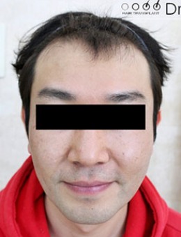 m秃顶图片分享，告诉你韩国黄盛柱医院如何植发