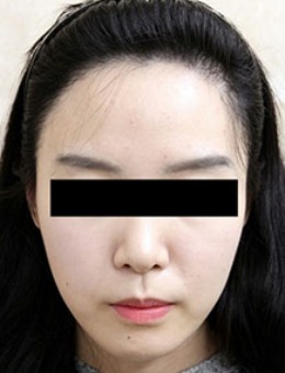 女生发际线高怎么矫正？韩国黄盛柱毛发移植案例帮你分析！