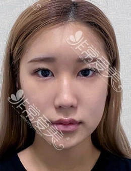 韩国优雅人鼻梁硅胶+鼻头(软骨)三个月恢复前后日记