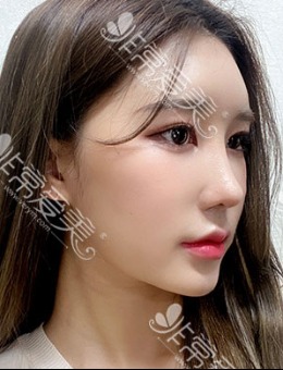 韩国优雅人鼻梁硅胶+鼻头(软骨)三个月恢复前后案例_术后