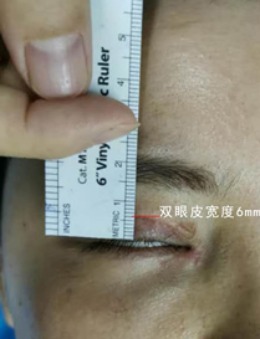 北京丽星翼美魏志香双眼皮修复即刻效果展示！