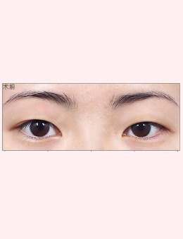 -韩国1mm整形医院双眼皮手术案例