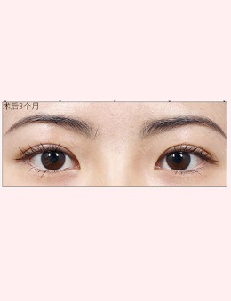 韩国1mm整形医院双眼皮手术案例