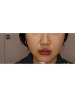 韩国江南Dayone医院面部瘦脸前后对比图