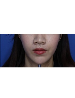 韩国江南Dayone医院V脸提升手术效果对比图