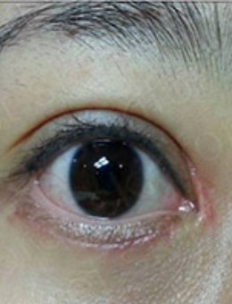-内眼角括号疤痕“非手术”去疤前后对比照
