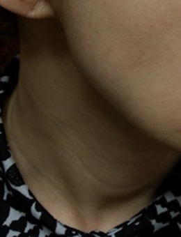 韩国思亲肤乐皮肤科去颈纹前后对比图