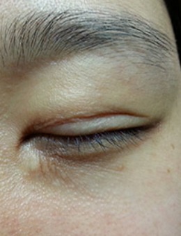 韩国思亲肤乐双眼皮失败疤痕修复前后对比照