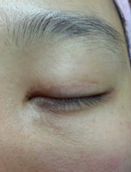 韩国思亲肤乐双眼皮失败疤痕修复前后对比照_术后