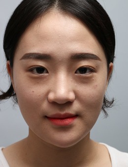 韩国德丽珍眼修复+鼻综合+全脸脂肪填充前后案例对比图_术前