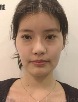 -韩国珠儿丽双眼皮修复+轮廓整形3个月跟踪恢复变化