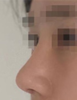 -韩国玉芭整形真人照片分享：福鼻+矮鼻 矫正两周效果