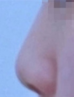 韩国玉芭整形真人照片分享：福鼻+矮鼻 矫正两周效果_术前