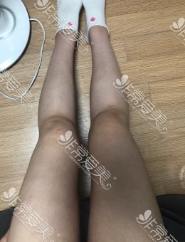 韩国梦线整形大腿抽脂3个月真人日记分享_术后