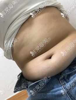 -韩国梦线整形外科吸脂瘦腰腹后背改善6个月对比照片