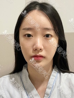 韩国优雅人整形初次肋骨隆鼻1个月恢复日记_术前