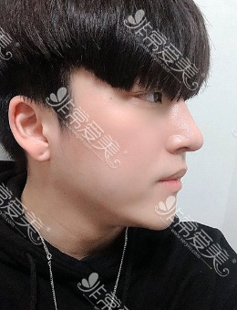 韩国优雅人男士肋骨鼻案例(包含前后对比图)_术后