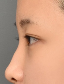 玻尿酸隆鼻+非切开眼形矫正手术前后对比照_术前