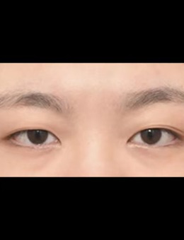 韩国ICON整形非切开眼肌矫正+取脂肪手术照片