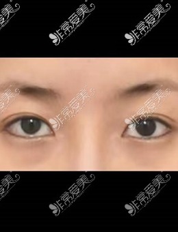 -韩国icon埋线双眼皮修复前后对比照片
