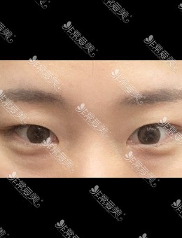 韩国icon整形三重埋线+眼底脂肪重置手术效果_术前
