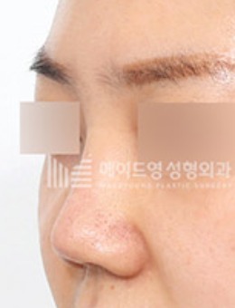 韩国美迪莹高难度挛缩鼻自体肋骨鼻修复案例