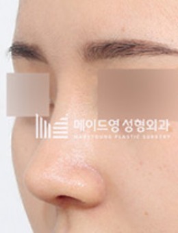 韩国美迪莹整形外科肋骨鼻修复照片_术后