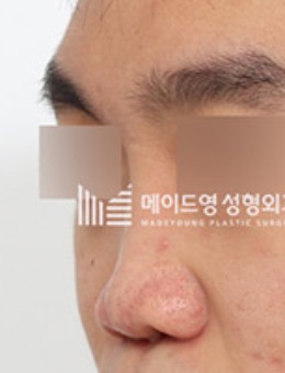 韩国美迪莹男士挛缩鼻手术前后对比