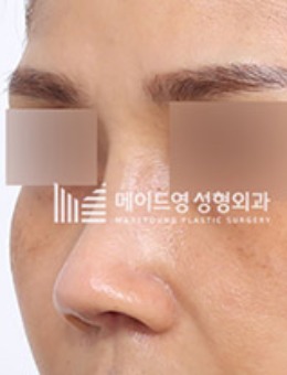 韩国美迪莹挛缩鼻修复照片图