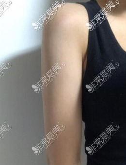 -韩国梦线整形手臂+大腿吸脂改善2个月恢复对比！