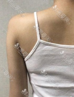 韩国梦线整形医院手臂+背部吸脂恢复日记