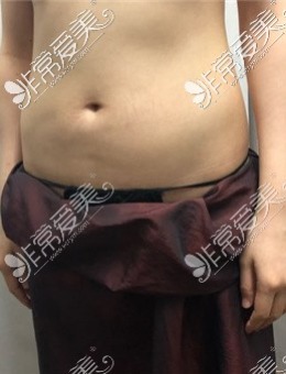 -韩国腰腹吸脂图片对比+手臂环吸亲身经历分享！