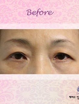 韩国CHERISH整形医院眼部提升手术效果图_术前