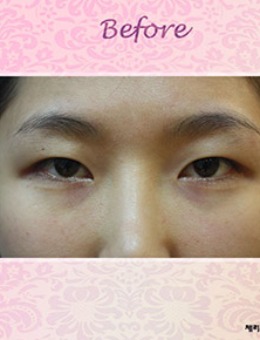 韩国CHERISH整形医院双眼皮手术案例