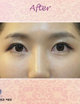韩国CHERISH整形医院双眼皮手术案例_术后